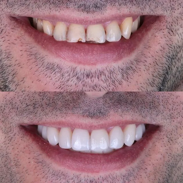 Antes e Depois 1