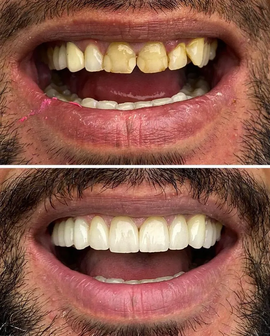 Antes e Depois 2