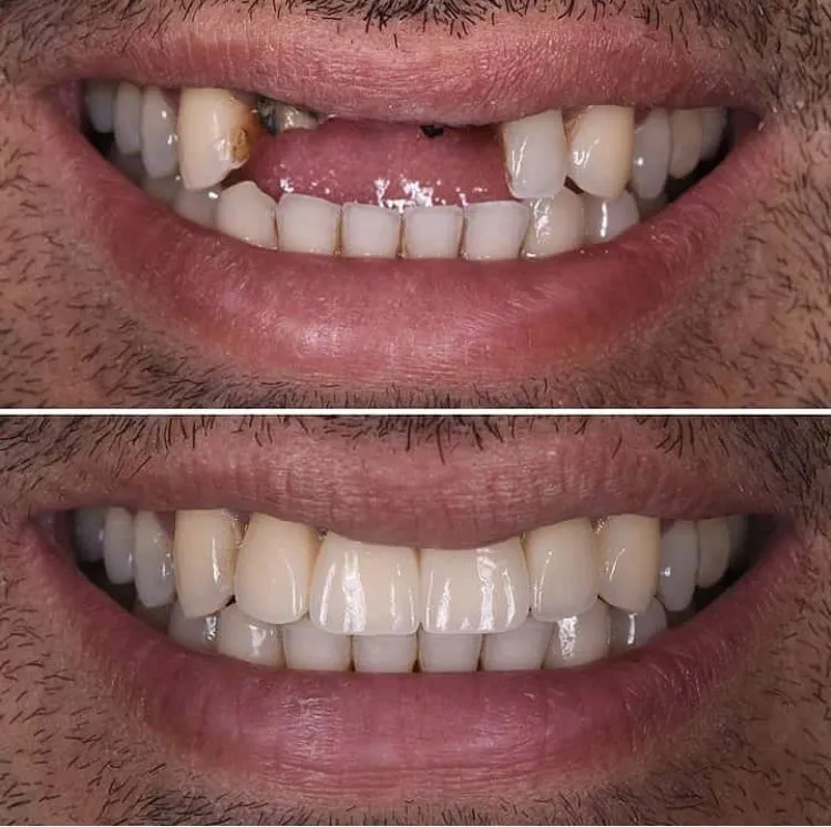Antes e Depois 3