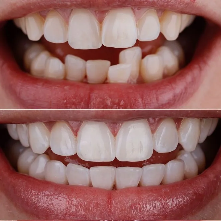 Antes e Depois 4